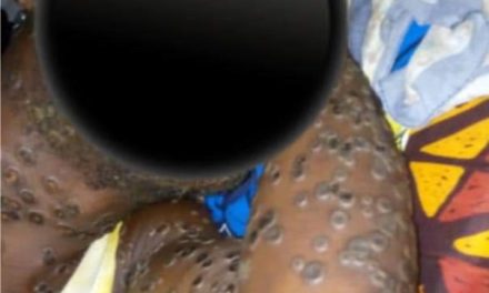Santé :L’épidémie de la variole de singe déclarée en Centrafrique : Tout comprendre sur la variole de singe (Monkey Pox)