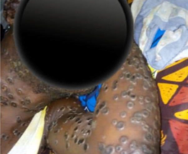 Santé :L’épidémie de la variole de singe déclarée en Centrafrique : Tout comprendre sur la variole de singe (Monkey Pox)