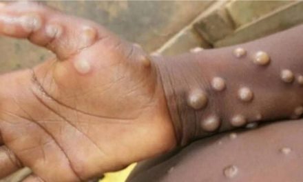 Le mpox frappe durement les enfants au Burundi