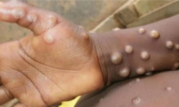 Le mpox frappe durement les enfants au Burundi