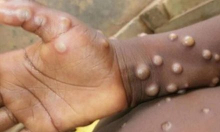 RDC : Ouverture de la campagne de vaccination contre le mpox 