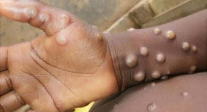 RDC : Ouverture de la campagne de vaccination contre le mpox